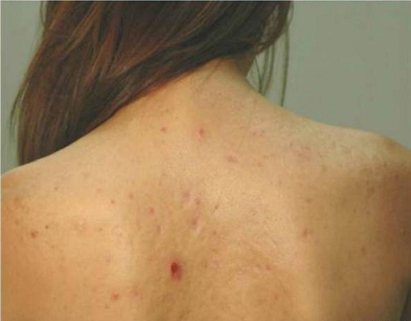 3 Loại Xà Phòng Trở Thành Bí Quyết Trị Mụn Lưng 1