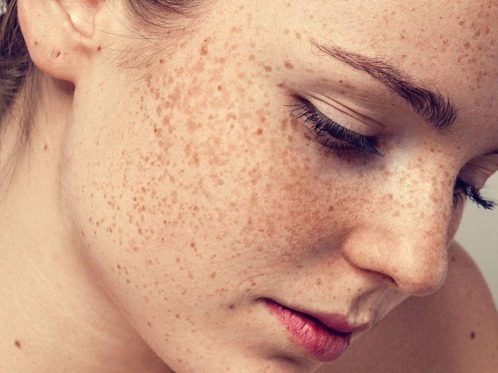 Bắn tàn nhang bằng tia laser có hết không? 1