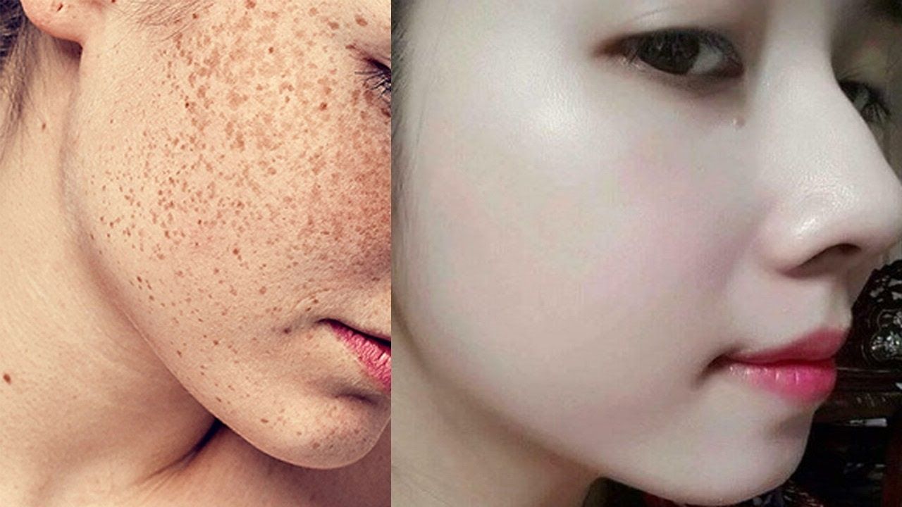Bắn tàn nhang bằng tia laser có hết không? 3