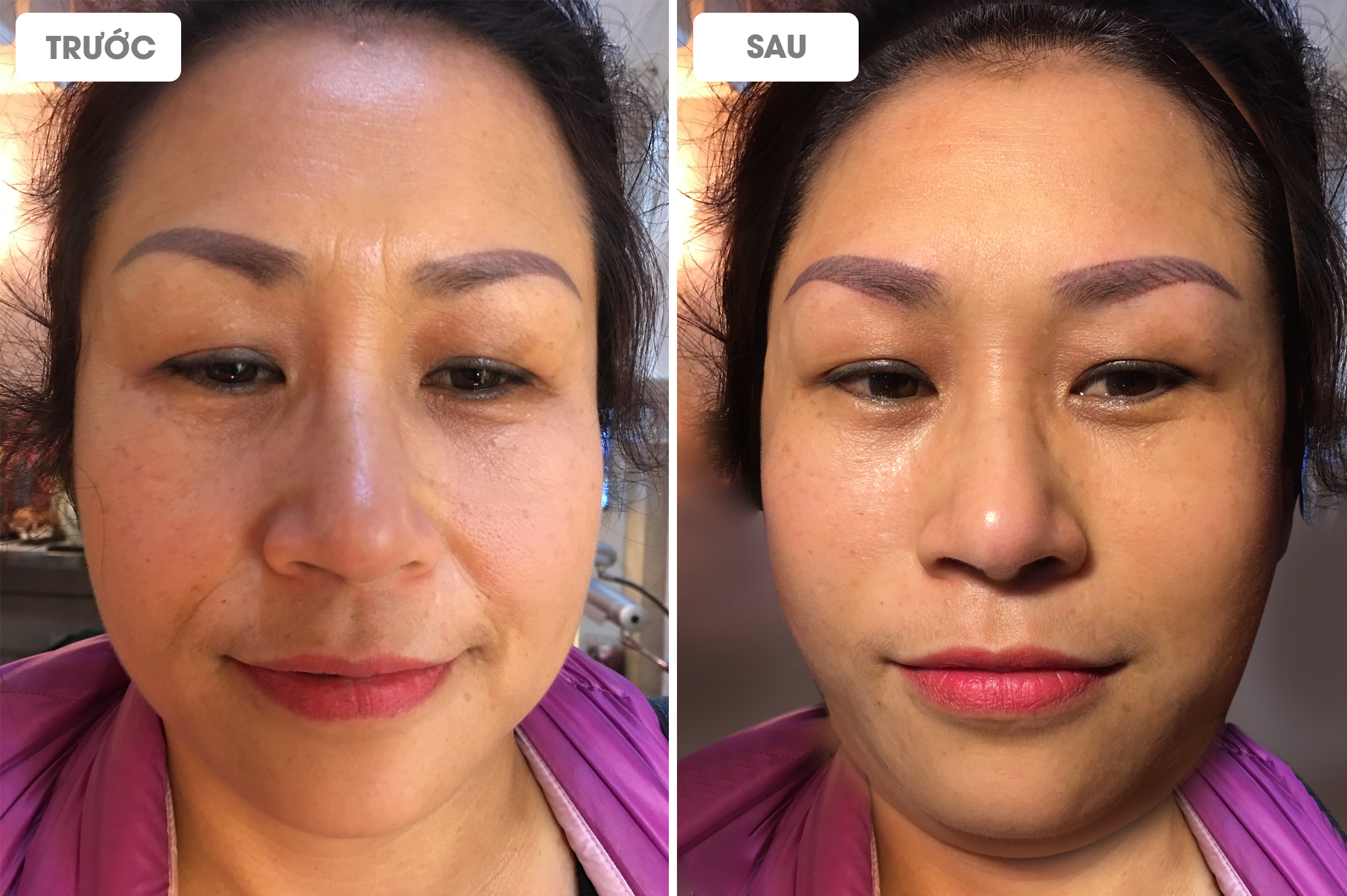 Căng chỉ rãnh cười “cứu cánh” cho làn da lão hóa 2