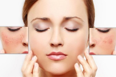 Có Nên Tái Tạo Da Mụn Bằng Thuốc Bắc Gia Truyền 1