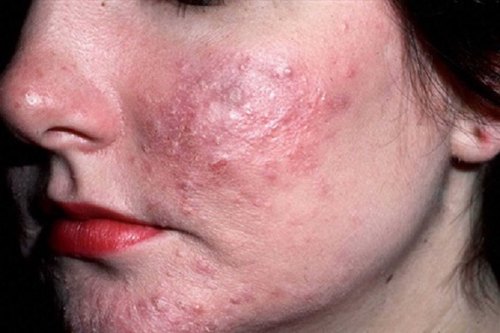 Có Nên Tái Tạo Da Mụn Bằng Thuốc Bắc Gia Truyền 2