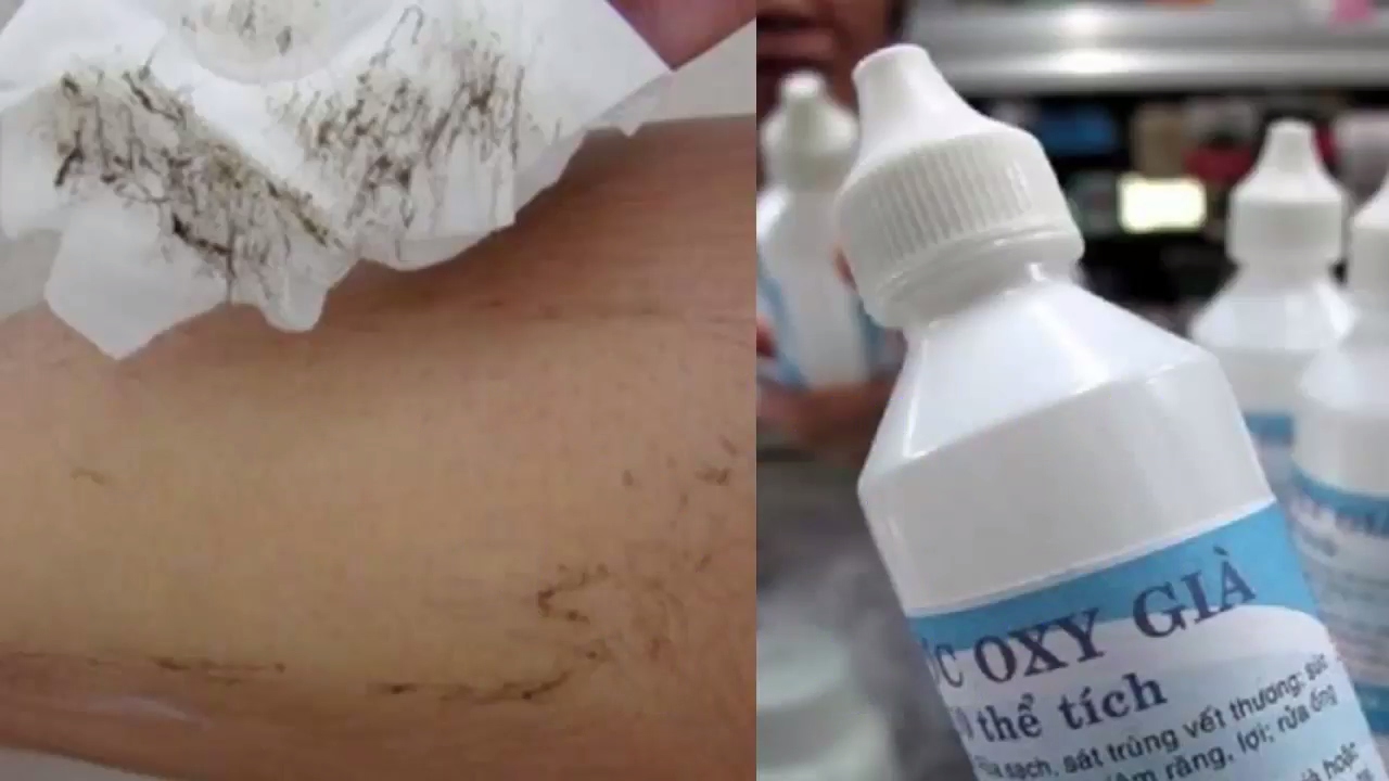 Tẩy lông chân bằng oxy già 1