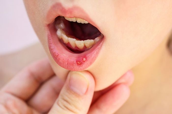 Cách trị nhiệt miệng 1