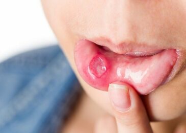 Hình ảnh nhiệt miệng