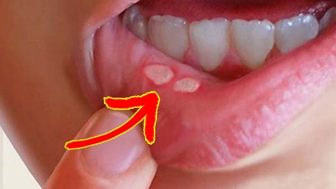 Những câu hỏi thường gặp về nhiệt miệng 2